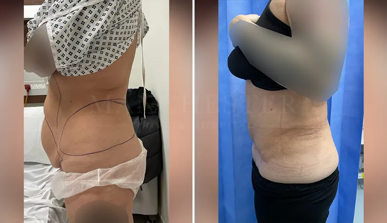 tummy tuck before and after result-8-v3