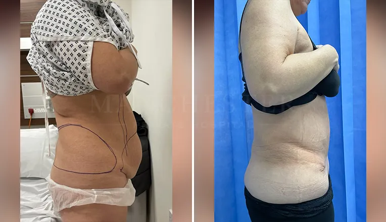 tummy tuck before and after result-8-v4