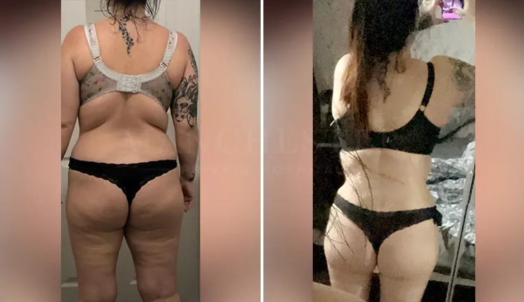 tummy tuck before and after results-5-v1