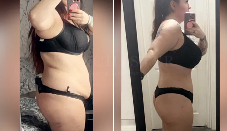 tummy tuck before and after results-5-v2