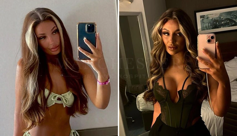breast enlargement patient results-9