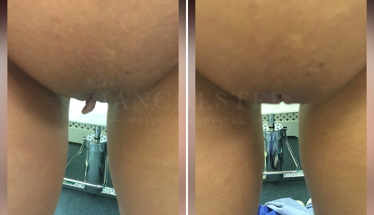 clitoral hood reduction before and after