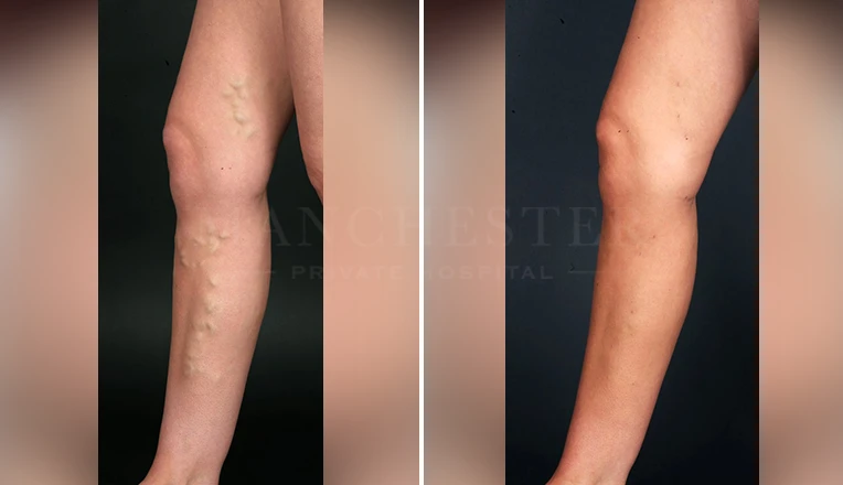 varicose veins treatment before and after result