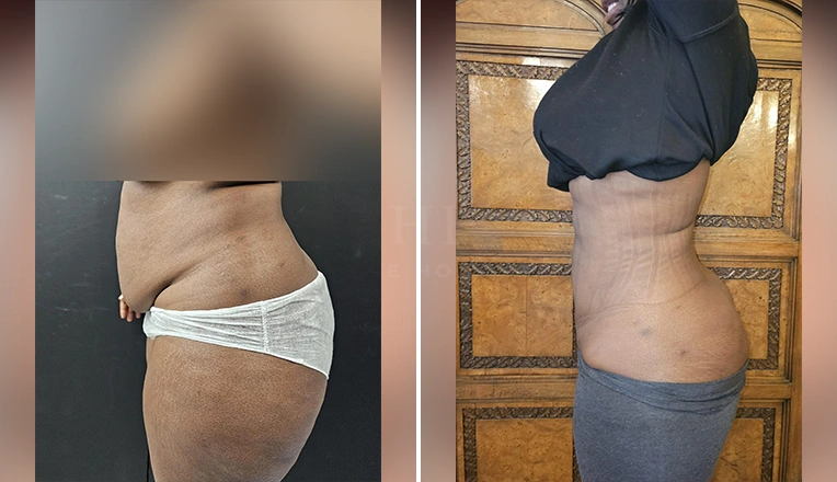 vaser lipo female abs before and after-4-v2