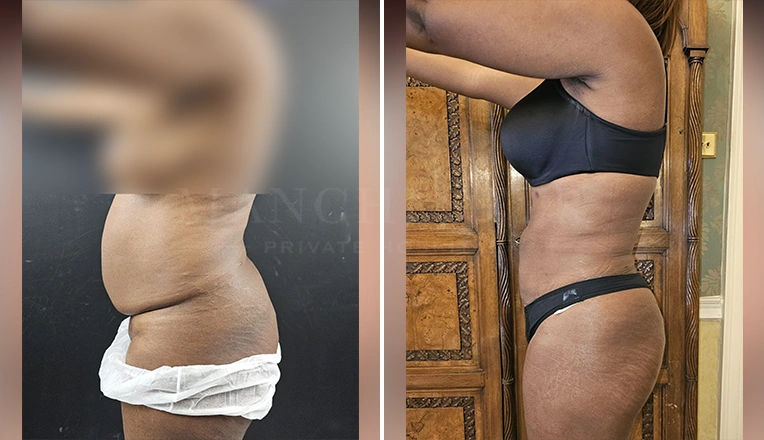 vaser lipo female abs before and after-5-v3