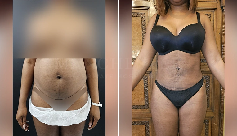 vaser lipo female abs before and after-5