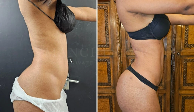 vaser lipo female abs before and after-6-v3