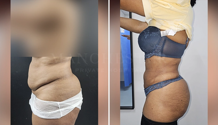 vaser lipo female abs before and after-9-v3