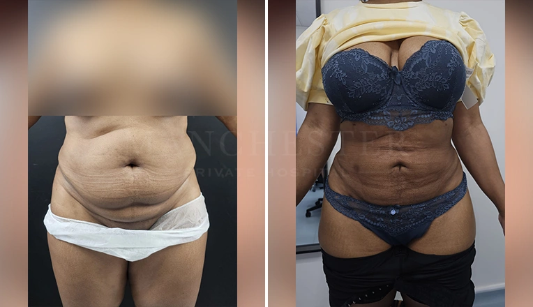 vaser lipo female abs before and after-9