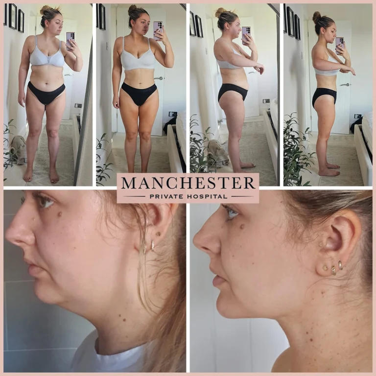 Sammy vaser liposuction before and after result