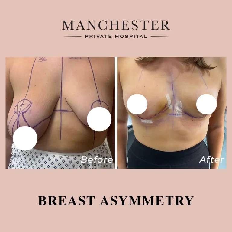 angel breast asymmetry before and after result