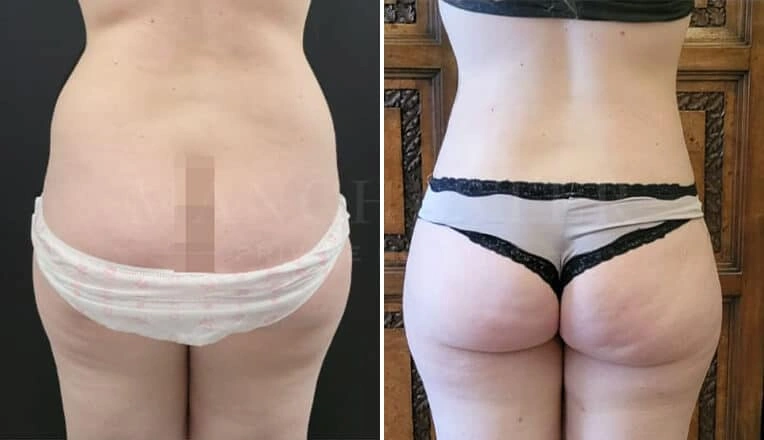 back-vaser-liposuction-before-and-after-3