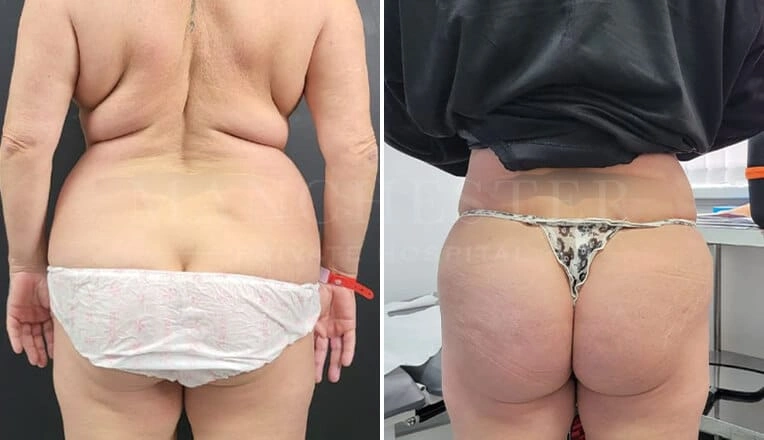 back-vaser-liposuction-before-and-after-5