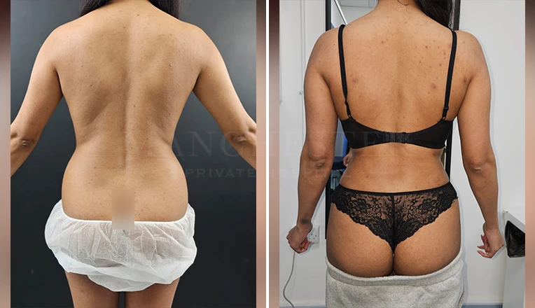 back vaser liposuction before and after-6