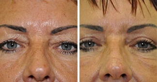 blepharoplasty-before-and-after-2