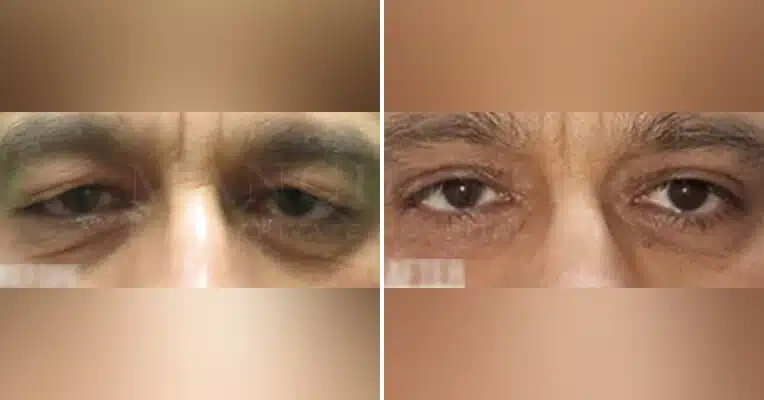 blepharoplasty-before-and-after