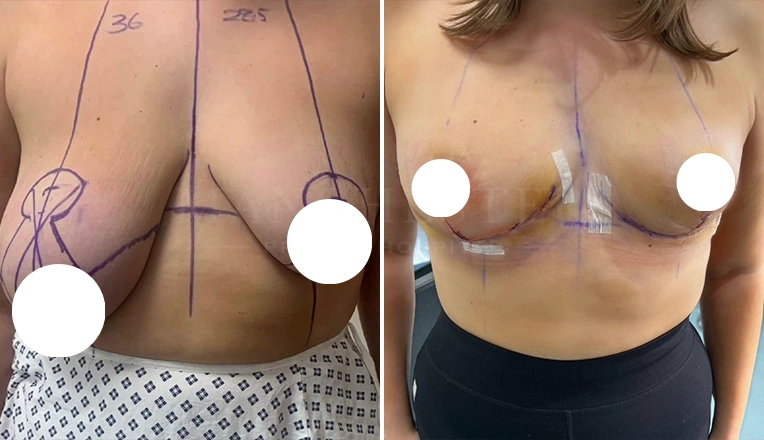 breast asymmetry before and after