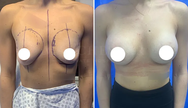 breast-enlargement-patient-results-8