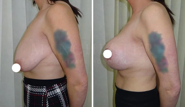 breast-lift-before-and-after-1