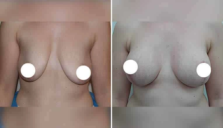 breast-lift-before-and-after-2