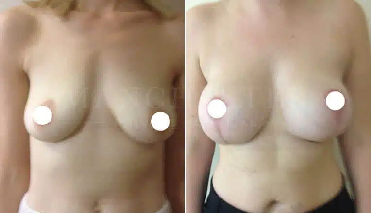 breast-lift-before-and-after-3