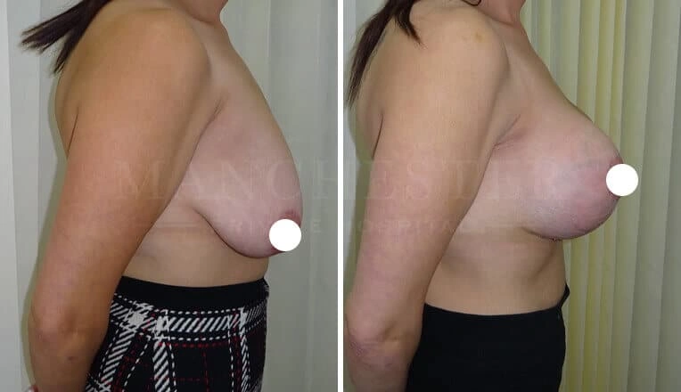 breast-lift-before-and-after-4