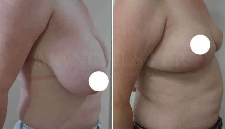 breast-reduction-before-and-after-1