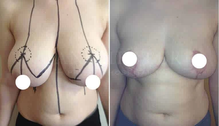 breast-reduction-before-and-after-2
