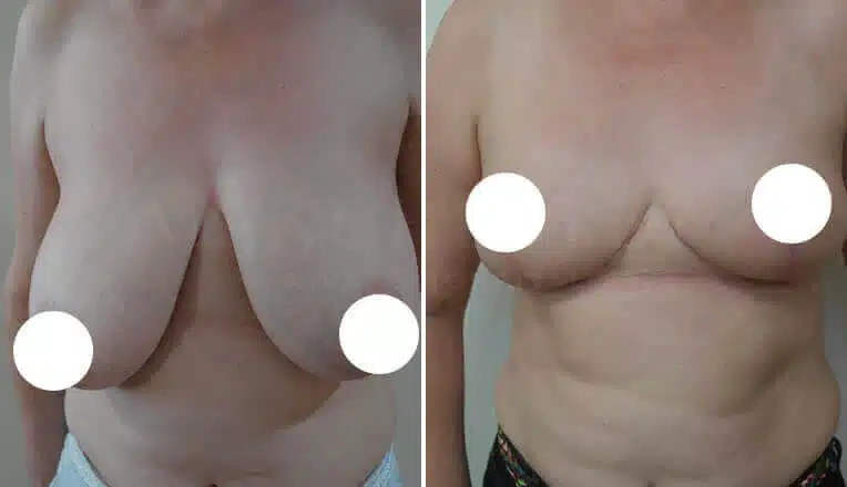 breast-reduction-before-and-after-uk-1