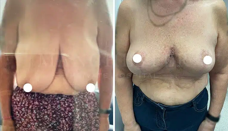 breast-reduction-before-and-after-uk