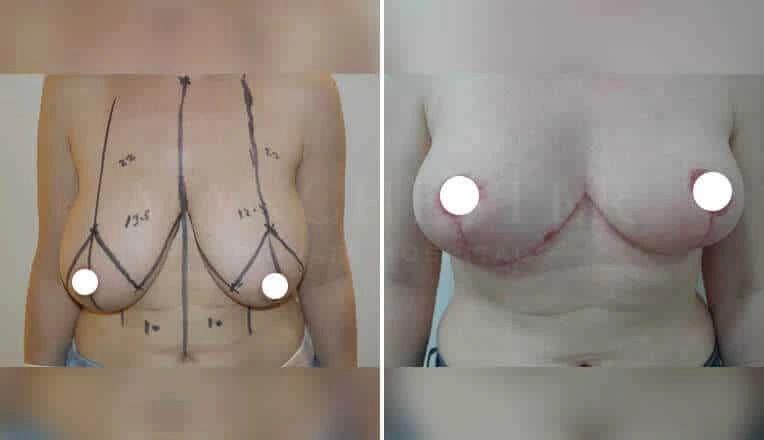 breast-reduction-before-and-after