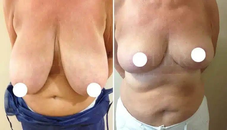 breast-reduction-surgery-before-and-after-1