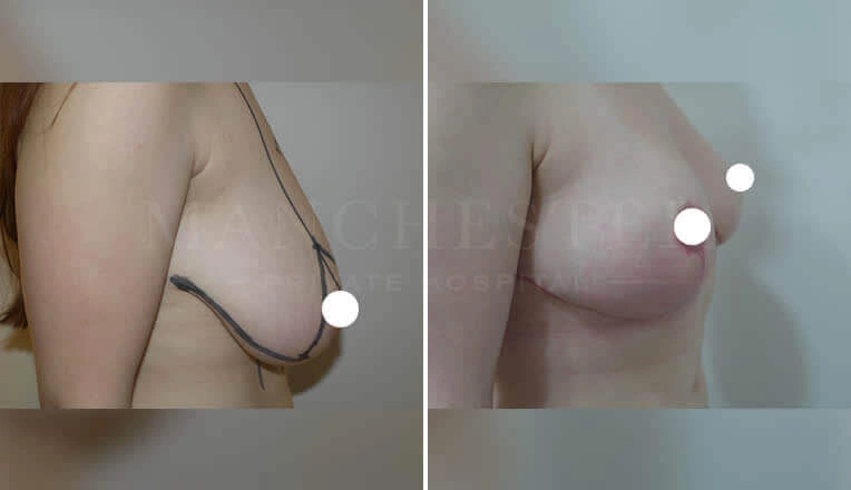 breast-reduction-surgery-before-and-after