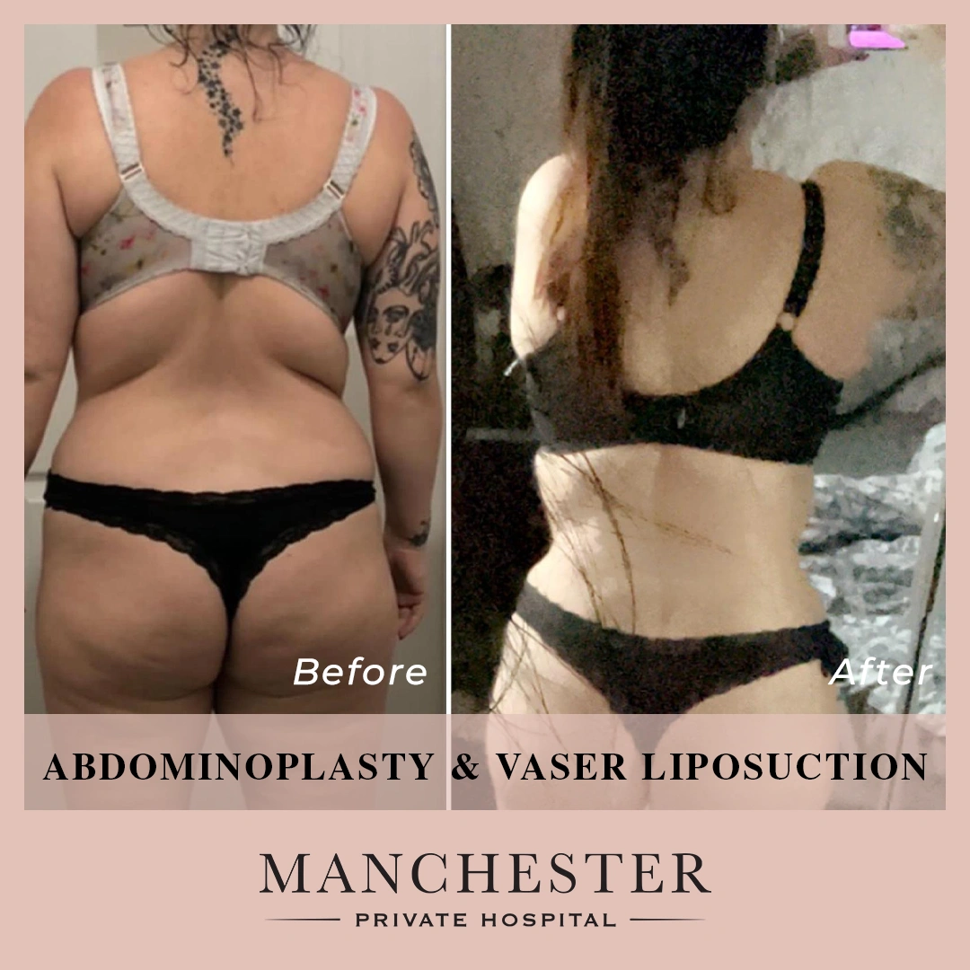 chelsea vaser liposuction and abdominoplasty result-1