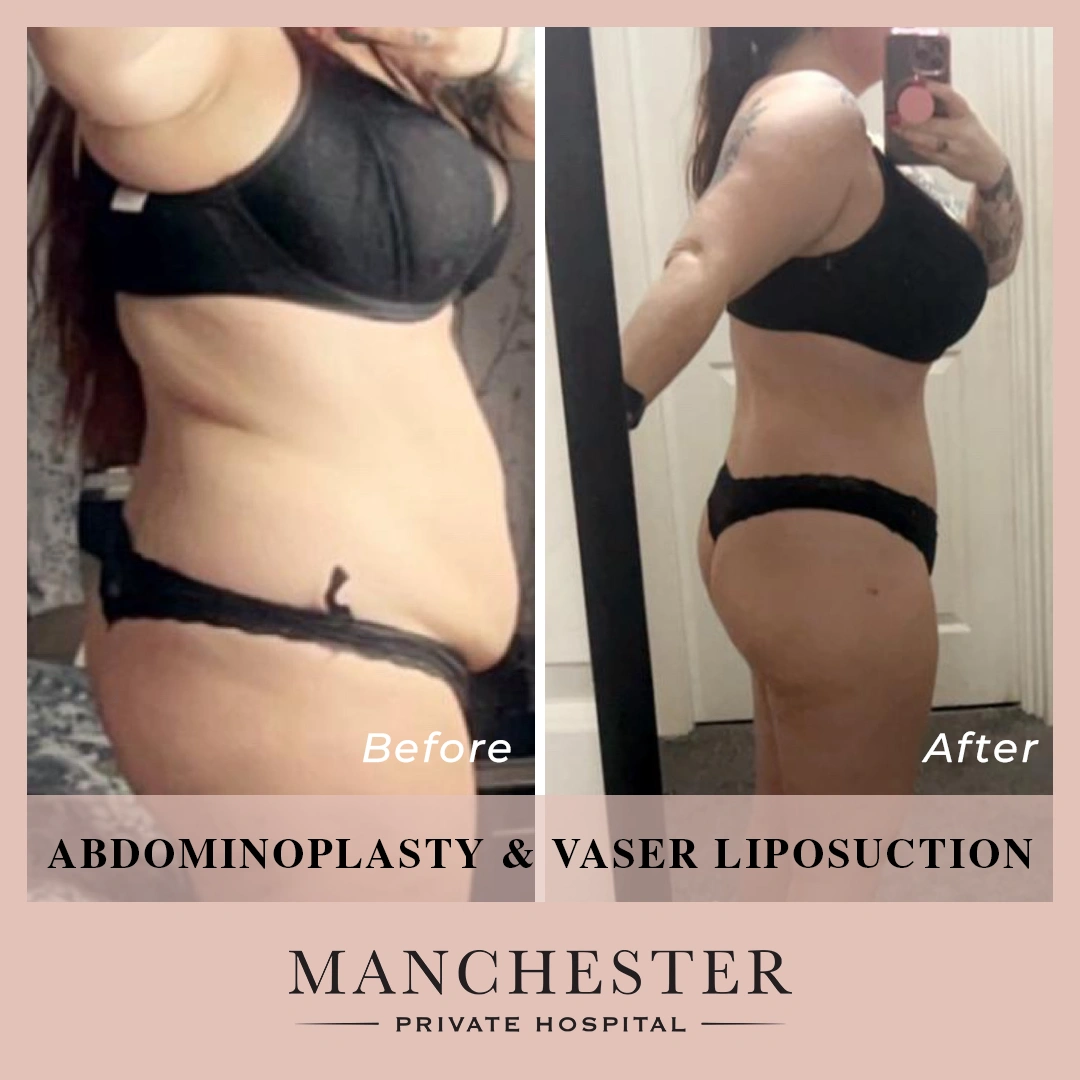 chelsea vaser liposuction and abdominoplasty result