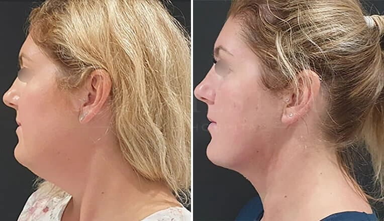 face-liposuction-before-and-after