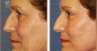 facelift-before-and-after-1