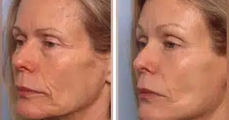 facelift-before-and-after-2