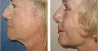 facelift-before-and-after-uk-1