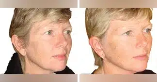 facelift-before-and-after-uk