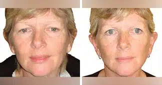 facelift-before-and-after
