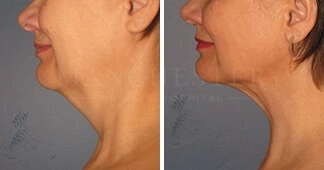 facial-lipo-before-and-after-1