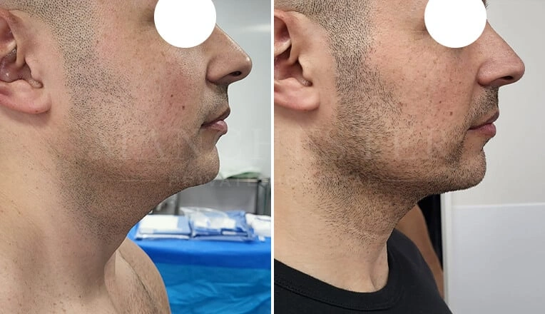 facial-liposuction-before-and-after-by-dr-kam-singh-1