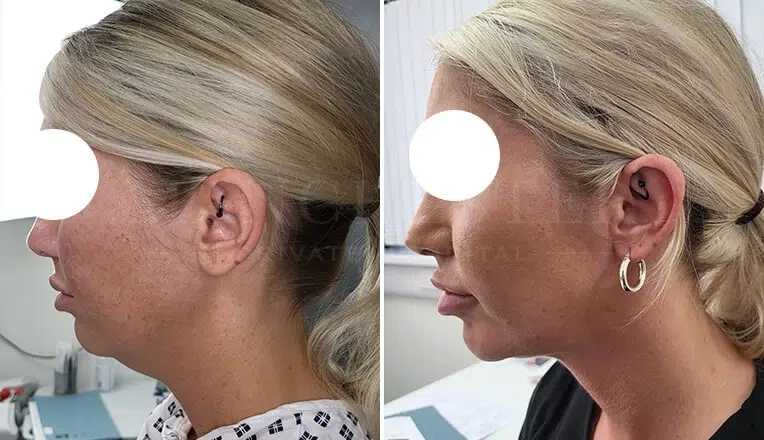 facial-liposuction-before-and-after-by-dr-kam-singh-2