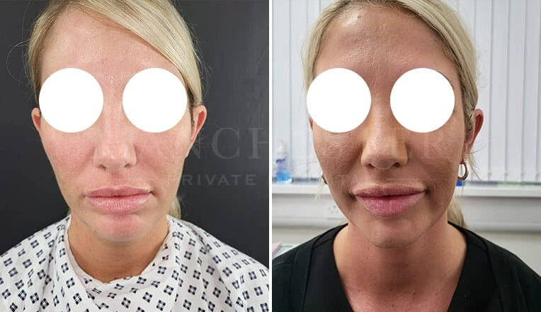 facial-liposuction-before-and-after-by-dr-kam-singh-4