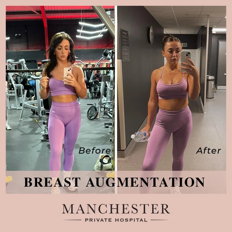 georgia breast enlargement before and after result
