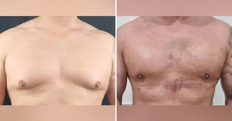 gynaecomastia-surgery-before-and-after-2