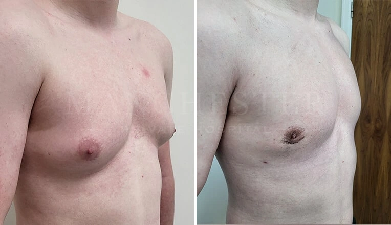 gynecomastia-before-and-after-by-dr-kam-singh-1-1-1
