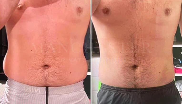gynecomastia-before-and-after-by-dr-kam-singh-10