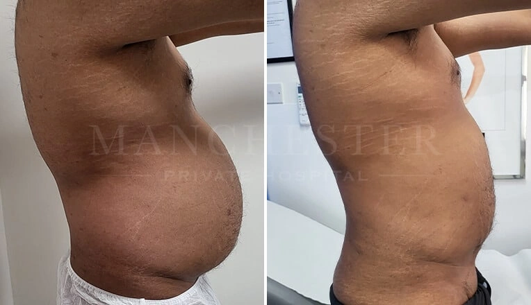 gynecomastia-before-and-after-by-dr-kam-singh-15